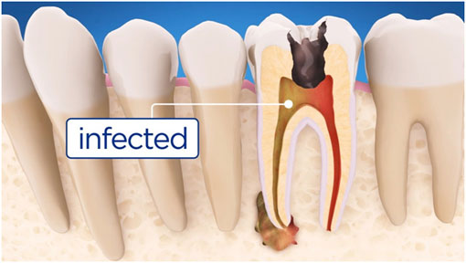 Root Canal Therapy