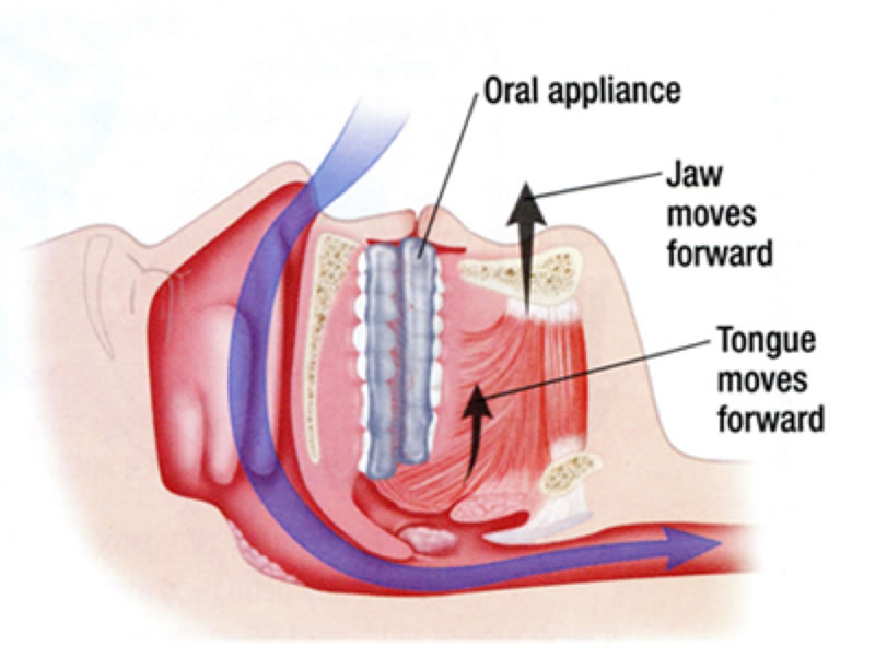 Sleep Apnea